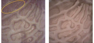 Sony Semiconductor Solutions Announces 1 mm Square Image Sensor for Medical Single-Use Endoscopes, Featuring Industry's First*¹5 m Digital Transmission and High Image Quality